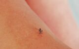 Mosquito sucked blood on human skin. Season of mosquitoes