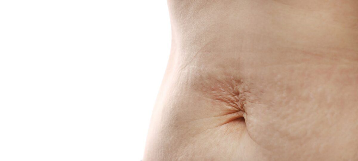 Close up of mother womans belly showing stretch mark loose lower abdomen skin she fat after pregnanc