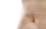 Close up of mother womans belly showing stretch mark loose lower abdomen skin she fat after pregnanc