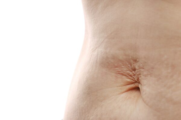 Close up of mother womans belly showing stretch mark loose lower abdomen skin she fat after pregnanc