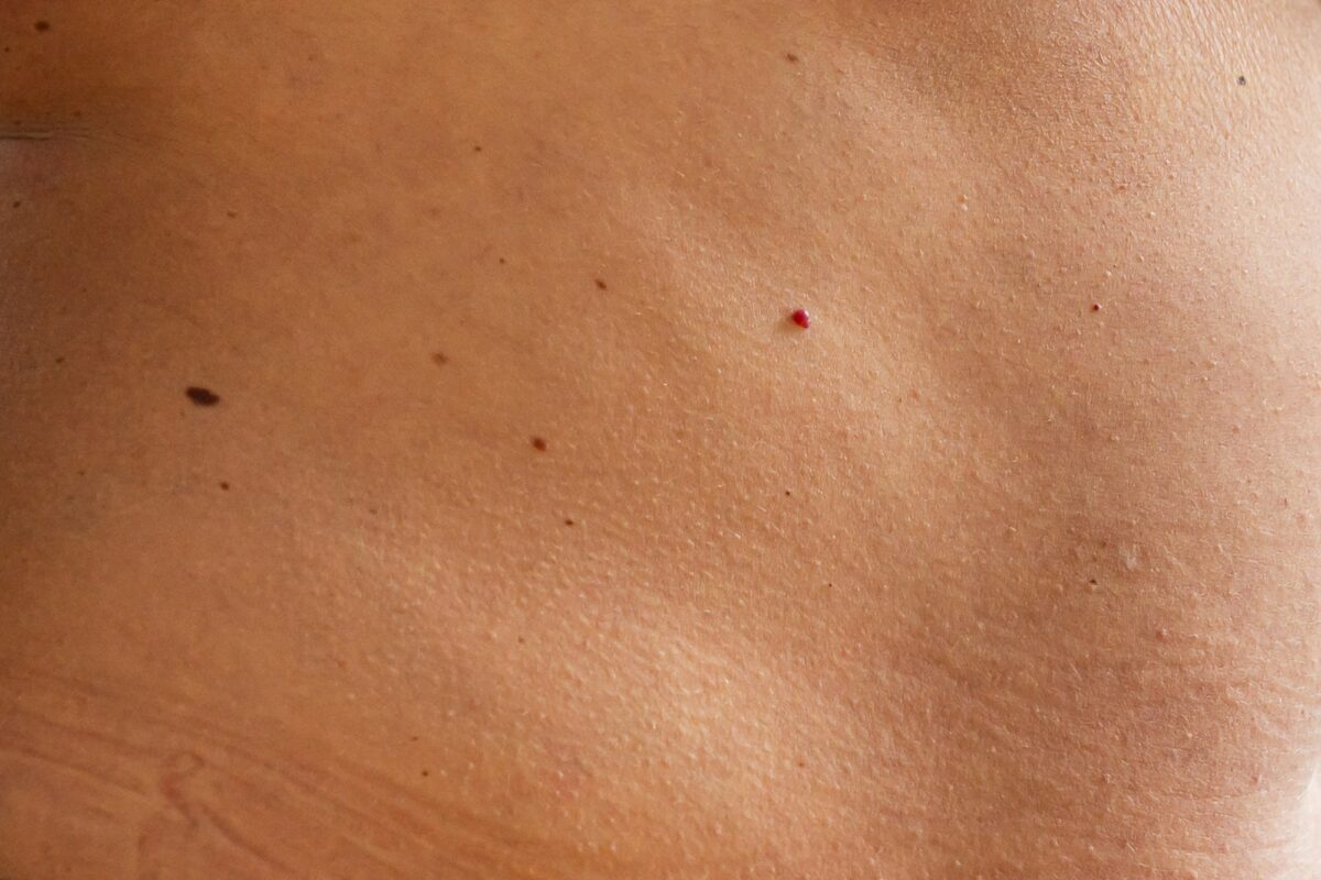 skin with moles