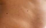 skin with moles