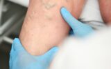 hlebologist examines a patient with varicose veins on his leg.