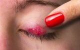 Chalazion reddened on the eyelid of a female eye