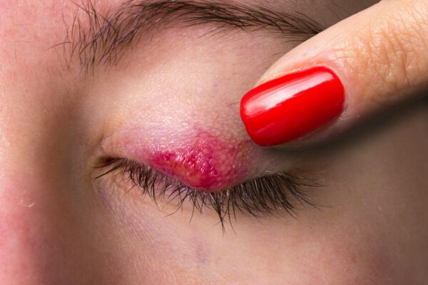 Chalazion reddened on the eyelid of a female eye