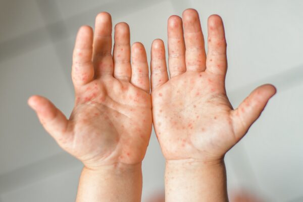 Enterovirus Leg arm mouth Rash on the body of a child Cocksackie virus